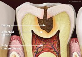 cvity-inside-chewing-surface